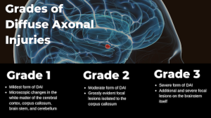 Brain Injury Lawyers | Diffuse Axonal Settlements and Lawsuits