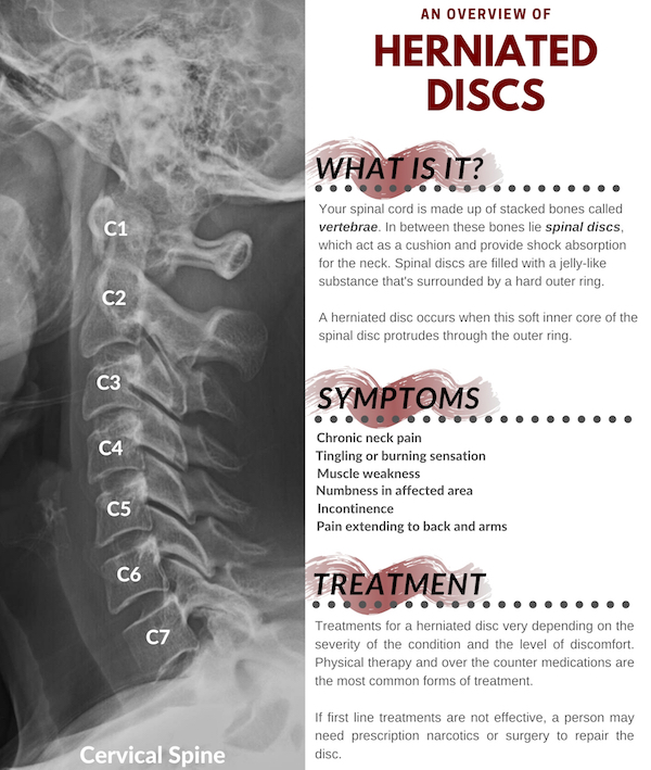 Disc Herniation and Sciatica - Welcome Back Clinic - MRI and Pain