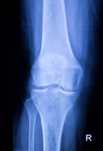 Broken Leg Mom Xxx - Broken Leg (Femur, Tibia, Fibula) Compensation Payouts (2023)