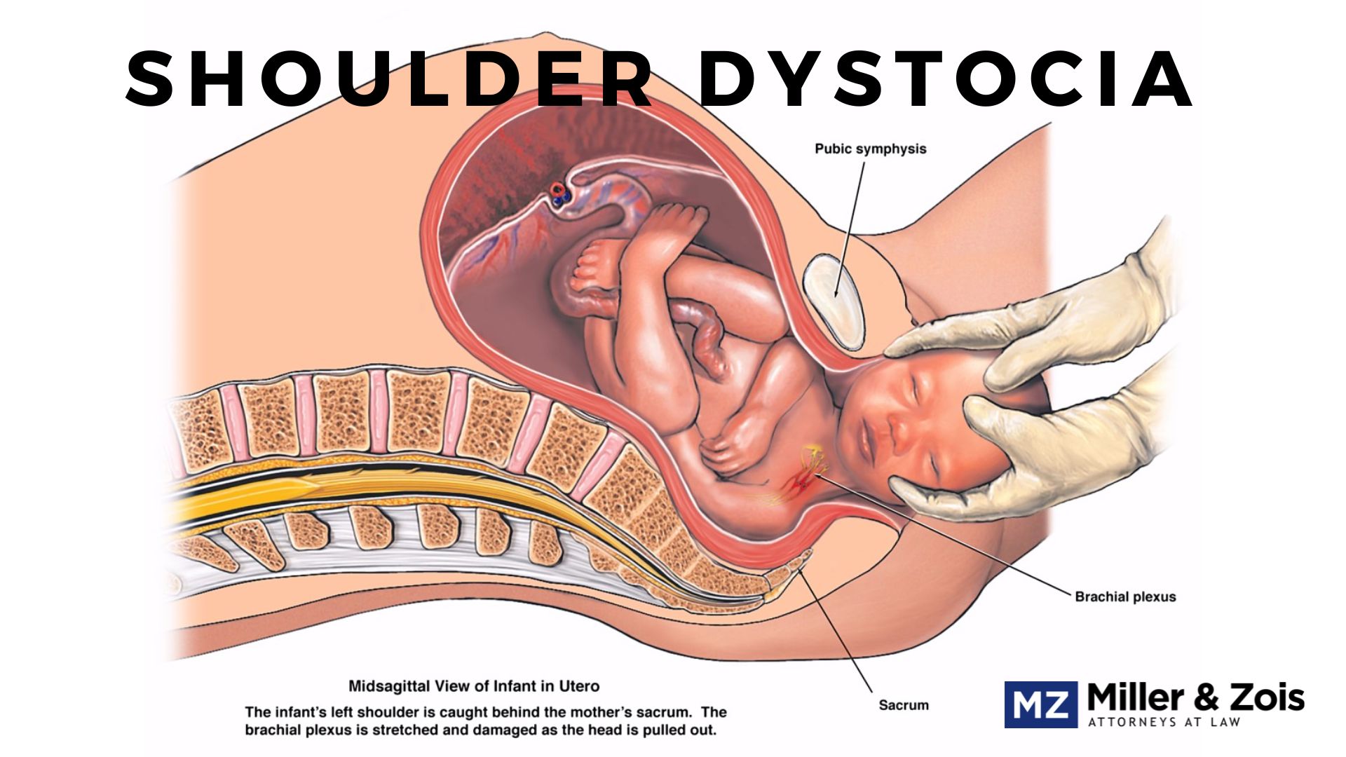 Shoulder-Dystocia-1