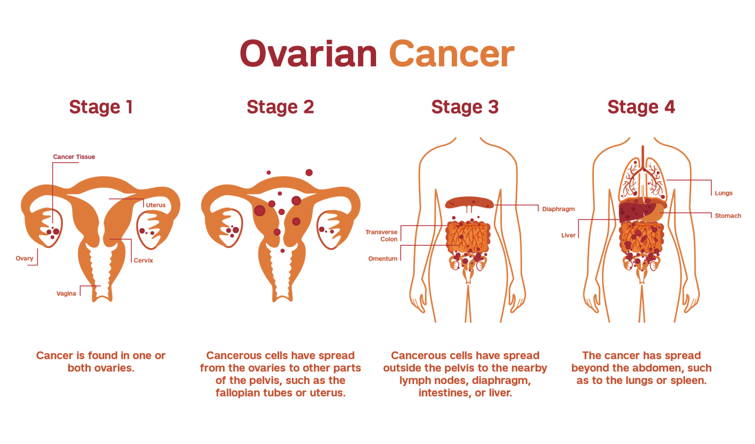 hair-relaxer-ovarian-cancer-lawsuit-january-2023